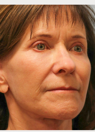 After Image: Facelift & Blepharoplasty – Dr. Howell - right-front-oblique