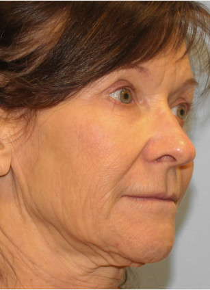 Before Image: Facelift & Blepharoplasty – Dr. Howell - right-front-oblique