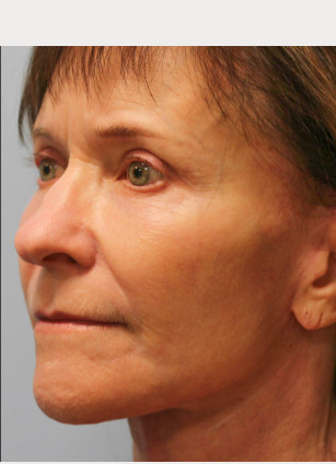 After Image: Facelift & Blepharoplasty – Dr. Howell - left-front-oblique