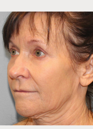 Before Image: Facelift & Blepharoplasty – Dr. Howell - left-front-oblique
