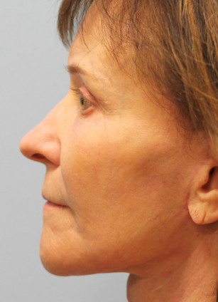 After Image: Facelift & Blepharoplasty – Dr. Howell - left-side