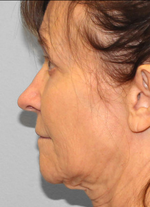 Before Image: Facelift & Blepharoplasty – Dr. Howell - left-side