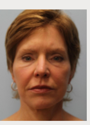 After Image: Facelift – Dr. Howell - front