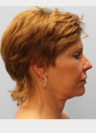 After Image: Facelift – Dr. Howell - other