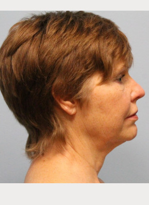 Before Image: Facelift – Dr. Howell - other