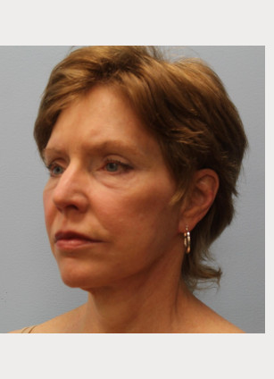 After Image: Facelift – Dr. Howell - other