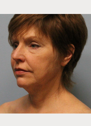 Before Image: Facelift – Dr. Howell - other
