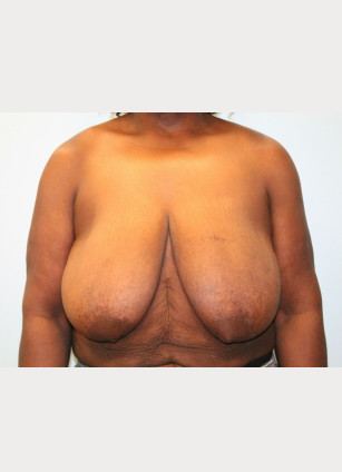 Before Image: Breast Reduction – Dr. Howell - front