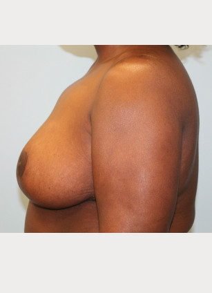 After Image: Breast Reduction – Dr. Howell - left-side