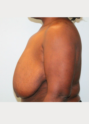 Before Image: Breast Reduction – Dr. Howell - left-side
