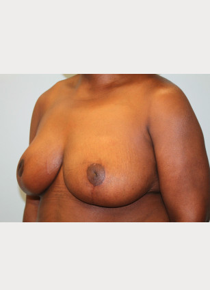 After Image: Breast Reduction – Dr. Howell - left-front-oblique