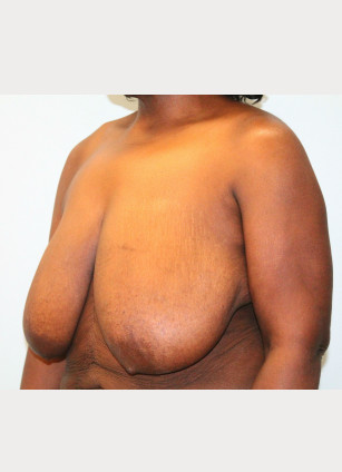 Before Image: Breast Reduction – Dr. Howell - left-front-oblique