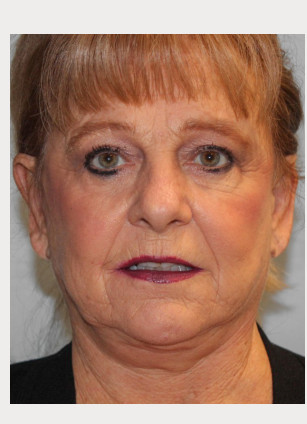 After Image: Otoplasty – Dr. Tucker - front
