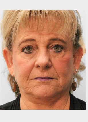 Before Image: Otoplasty – Dr. Tucker - front