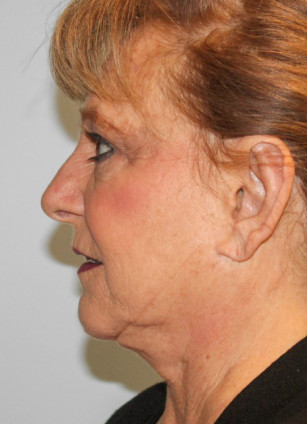 After Image: Otoplasty – Dr. Tucker - left-side