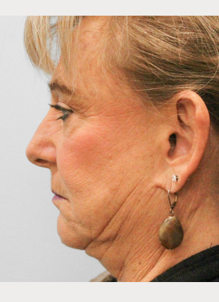 Before Image: Otoplasty – Dr. Tucker - left-side