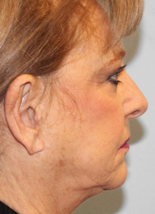 After Image: Otoplasty – Dr. Tucker - front