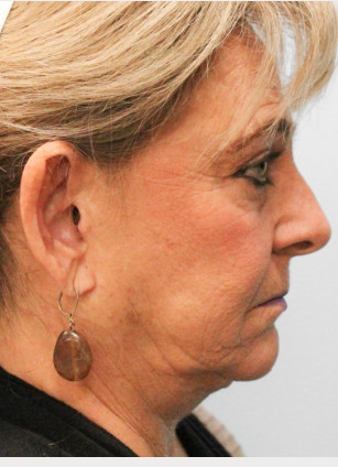 Before Image: Otoplasty – Dr. Tucker - front