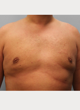 After Image: Gynecomastia – Dr. Tucker - front