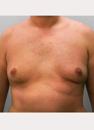 Before Image: Gynecomastia – Dr. Tucker - front