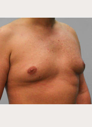 Before Image: Gynecomastia – Dr. Tucker - right-front-oblique