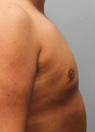 After Image: Gynecomastia – Dr. Tucker - right-side