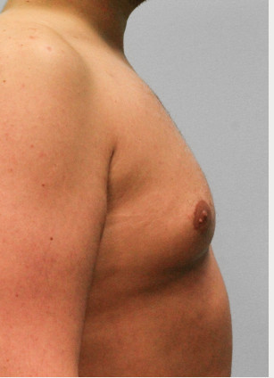 Before Image: Gynecomastia – Dr. Tucker - right-side