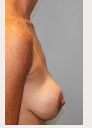 Before Image: Breast Augmentation – Dr. Tucker - right-side