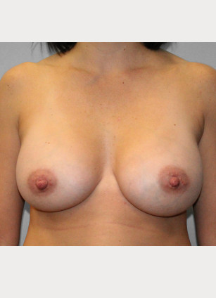 After Image: Breast Augmentation -Dr. Tucker - front