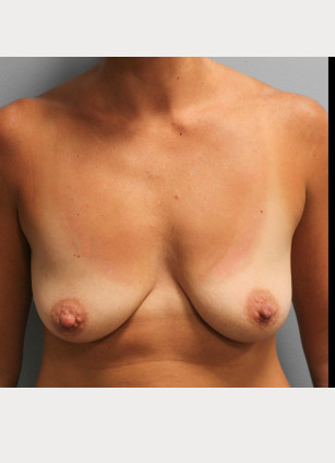 Before Image: Breast Augmentation -Dr. Tucker - front