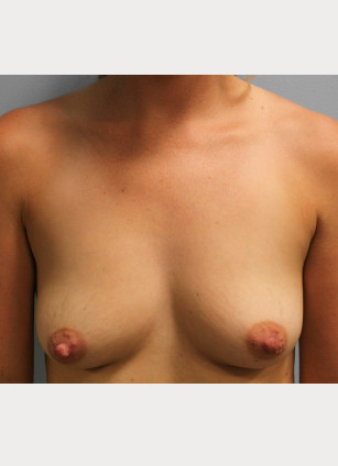 Before Image: Breast Augmentation – Dr. Tucker - front