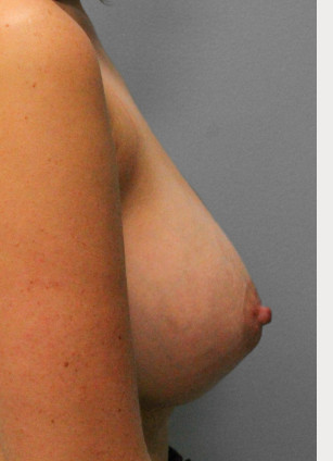 After Image: Breast Augmentation – Dr. Tucker - right-side