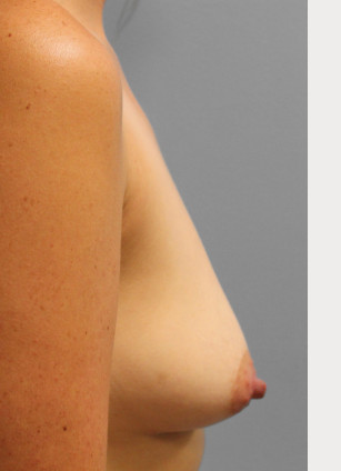 Before Image: Breast Augmentation – Dr. Tucker - right-side