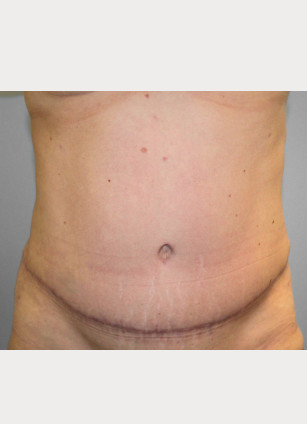 After Image: Abdominoplasty (Tummy Tuck) – Dr. Tucker - front