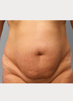 Before Image: Abdominoplasty (Tummy Tuck) – Dr. Tucker - front