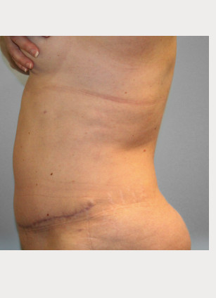 After Image: Abdominoplasty (Tummy Tuck) – Dr. Tucker - left-front-oblique