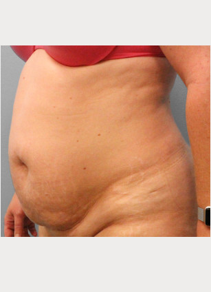 Before Image: Abdominoplasty (Tummy Tuck) – Dr. Tucker - left-front-oblique