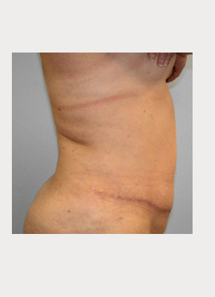 After Image: Abdominoplasty (Tummy Tuck) – Dr. Tucker - right-side