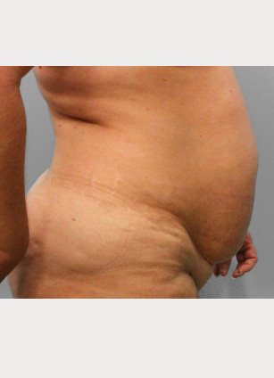 Before Image: Abdominoplasty (Tummy Tuck) – Dr. Tucker - right-side