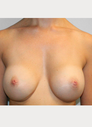 After Image: Breast Augmentation – Dr. Tucker - front