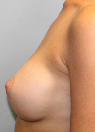 After Image: Breast Augmentation – Dr. Tucker - left-side