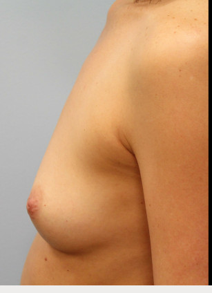 Before Image: Breast Augmentation – Dr. Tucker - left-side