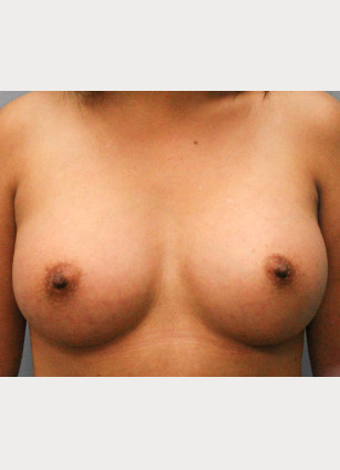 After Image: Breast Augmentation – Dr. Tucker - front