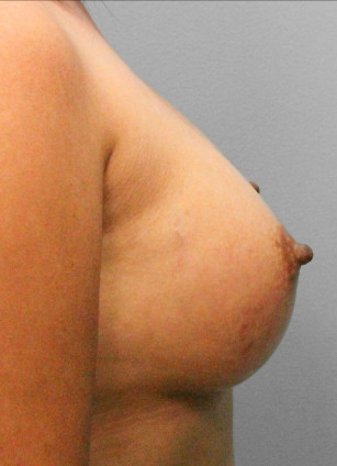 After Image: Breast Augmentation – Dr. Tucker - right-side