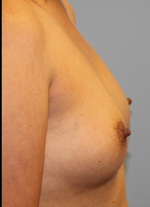 Before Image: Breast Augmentation – Dr. Tucker - right-side