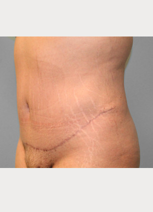 After Image: Abdominoplasty & Flank Lipo – Dr. Tucker - left-front-oblique