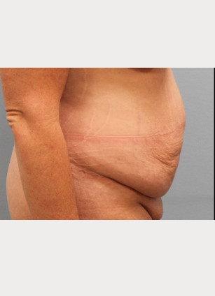 Before Image: Abdominoplasty & Flank Lipo – Dr. Tucker - right-side