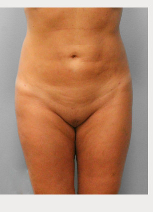 After Image: Smart Lipo – Dr. Tucker - front