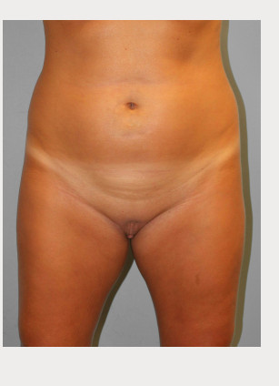 Before Image: Smart Lipo – Dr. Tucker - front