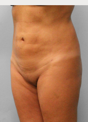 After Image: Smart Lipo – Dr. Tucker - left-front-oblique